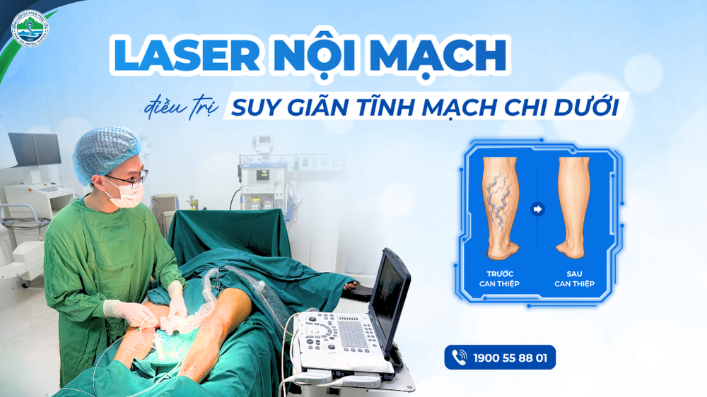 Điều trị suy giãn tĩnh mạch chi dưới bằng Laser Nội mạch