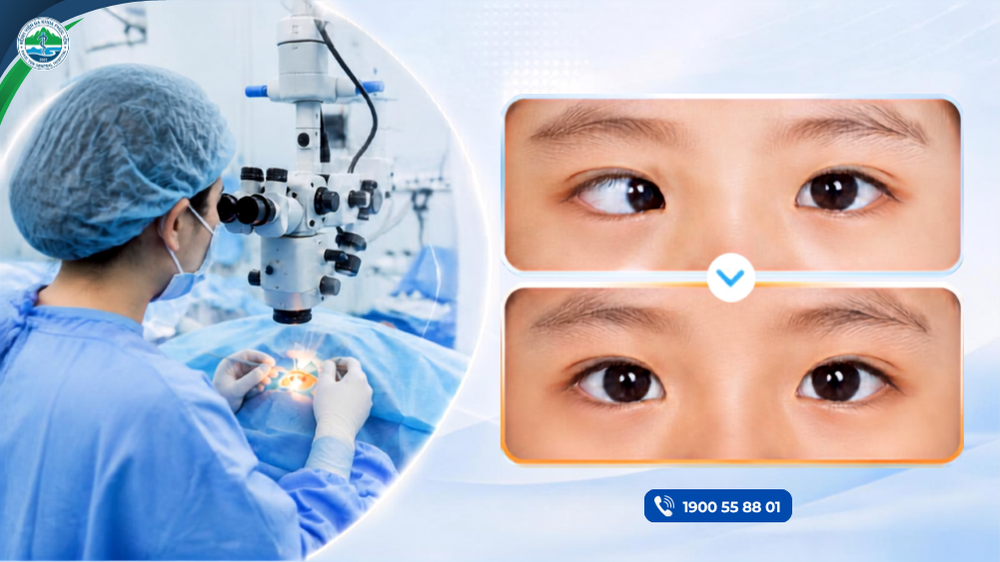Phẫu thuật lác mắt – Cải thiện thị giác, tăng tính thẩm mỹ