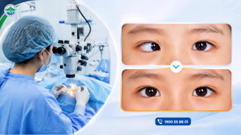 Phẫu thuật lác mắt – Cải thiện thị giác, tăng tính thẩm mỹ
